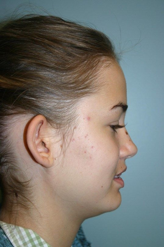 Ear Surgery Before & After