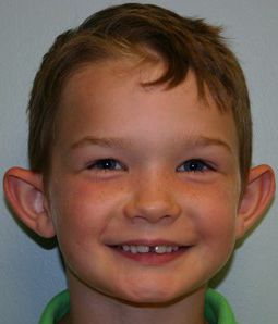 Ear Surgery Before & After