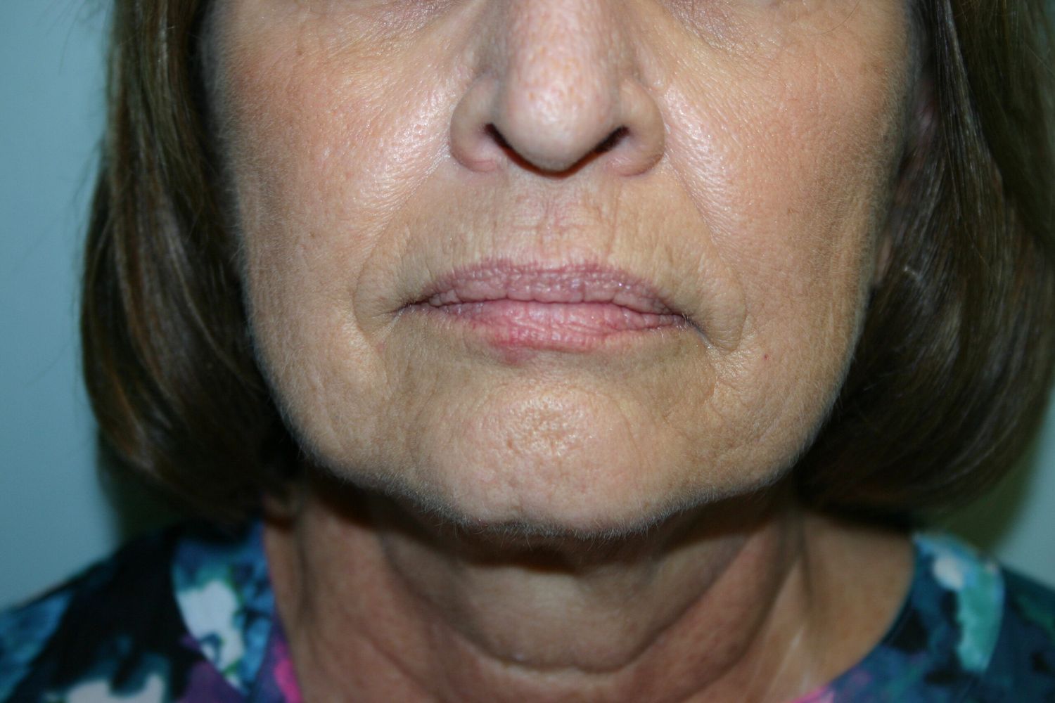 Croton Oil Peel Before & After