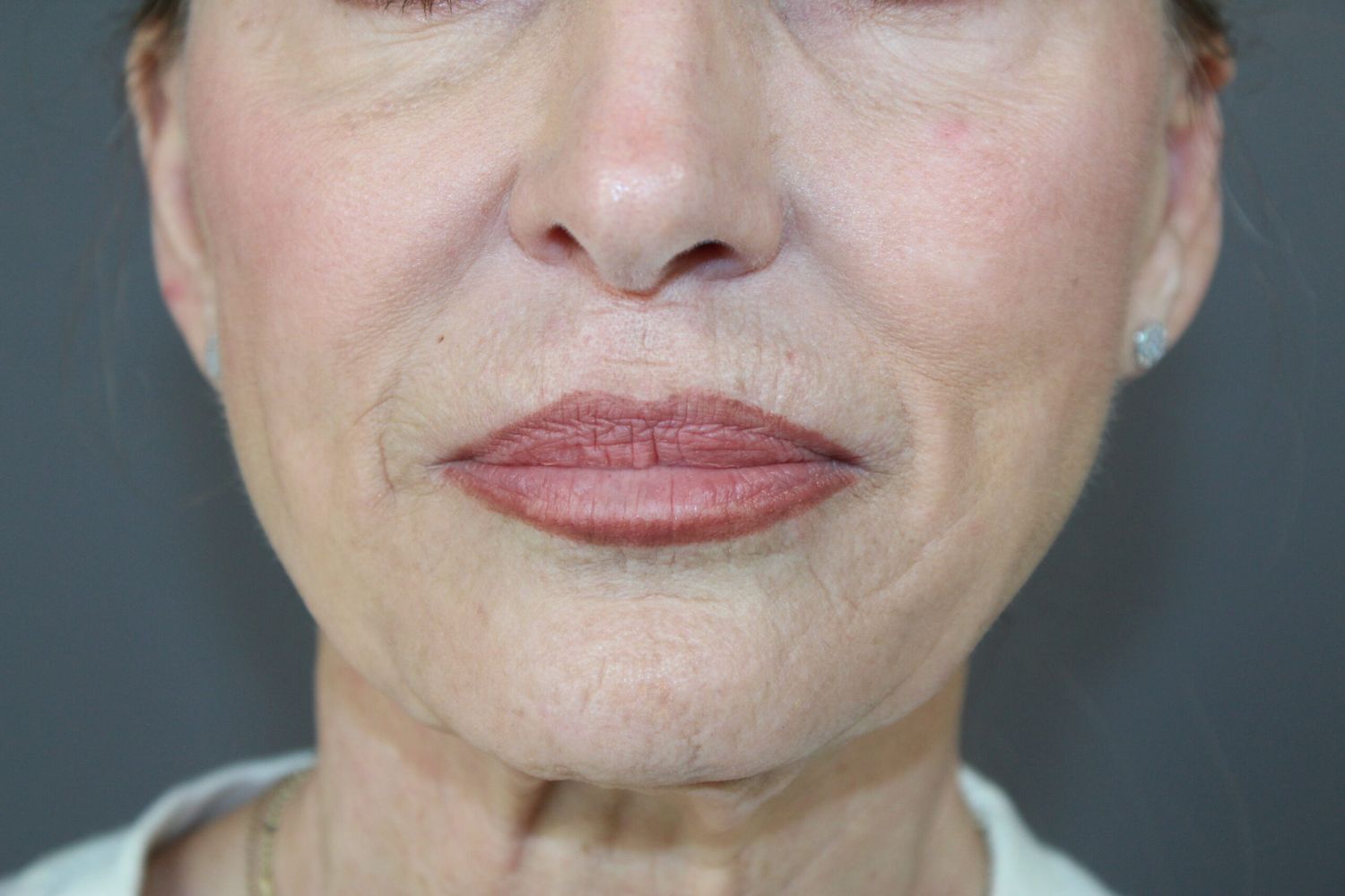 Croton Oil Peel Before & After