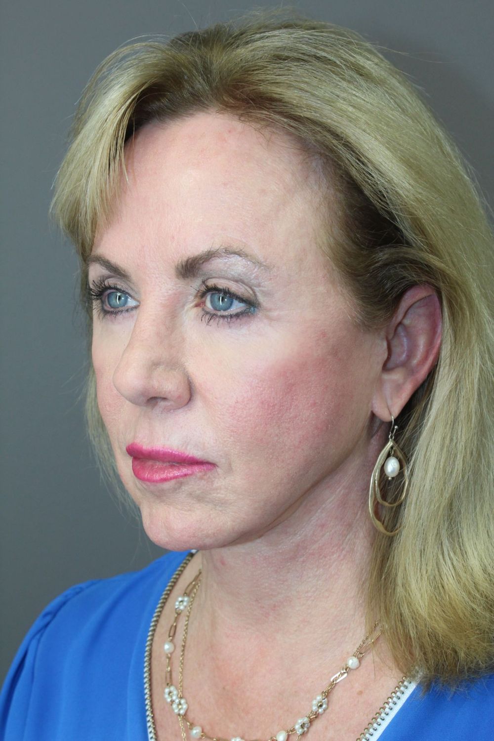 Croton Oil Peel Before & After