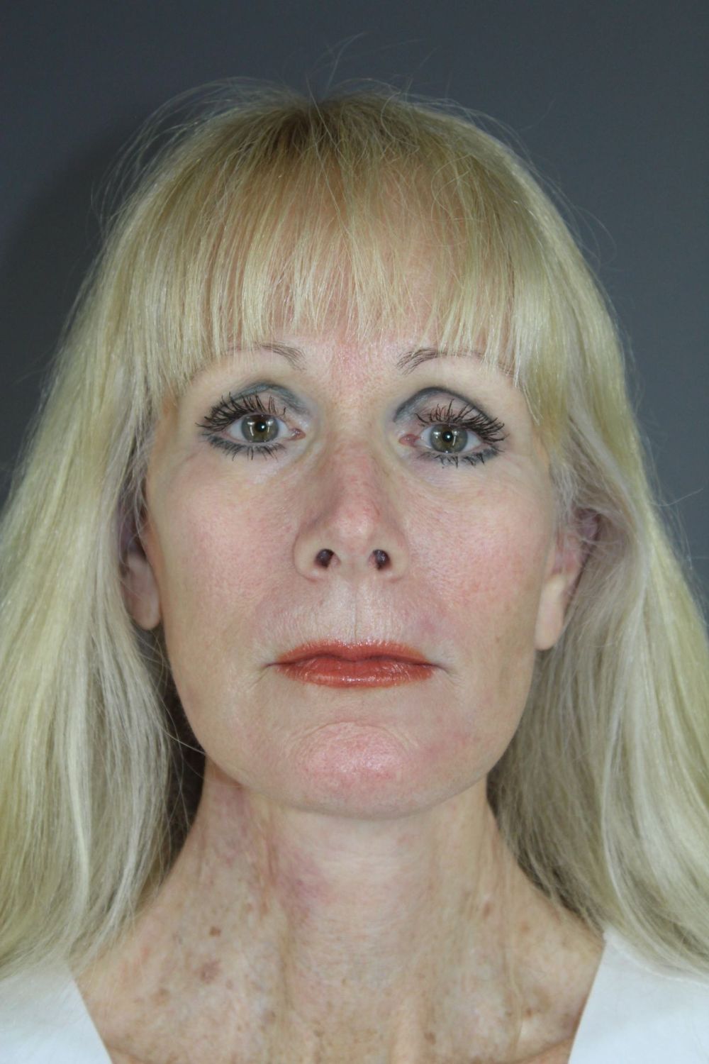 Croton Oil Peel Before & After