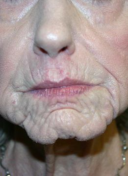 Croton Oil Peel Before & After