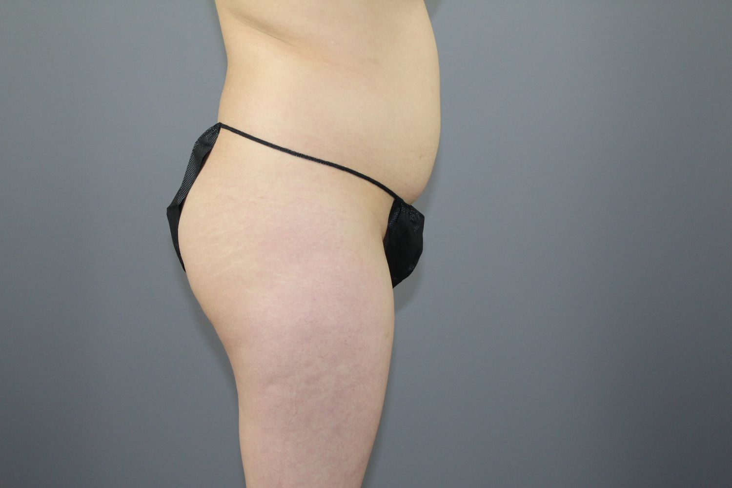 Brazilian Butt Lift Before & After