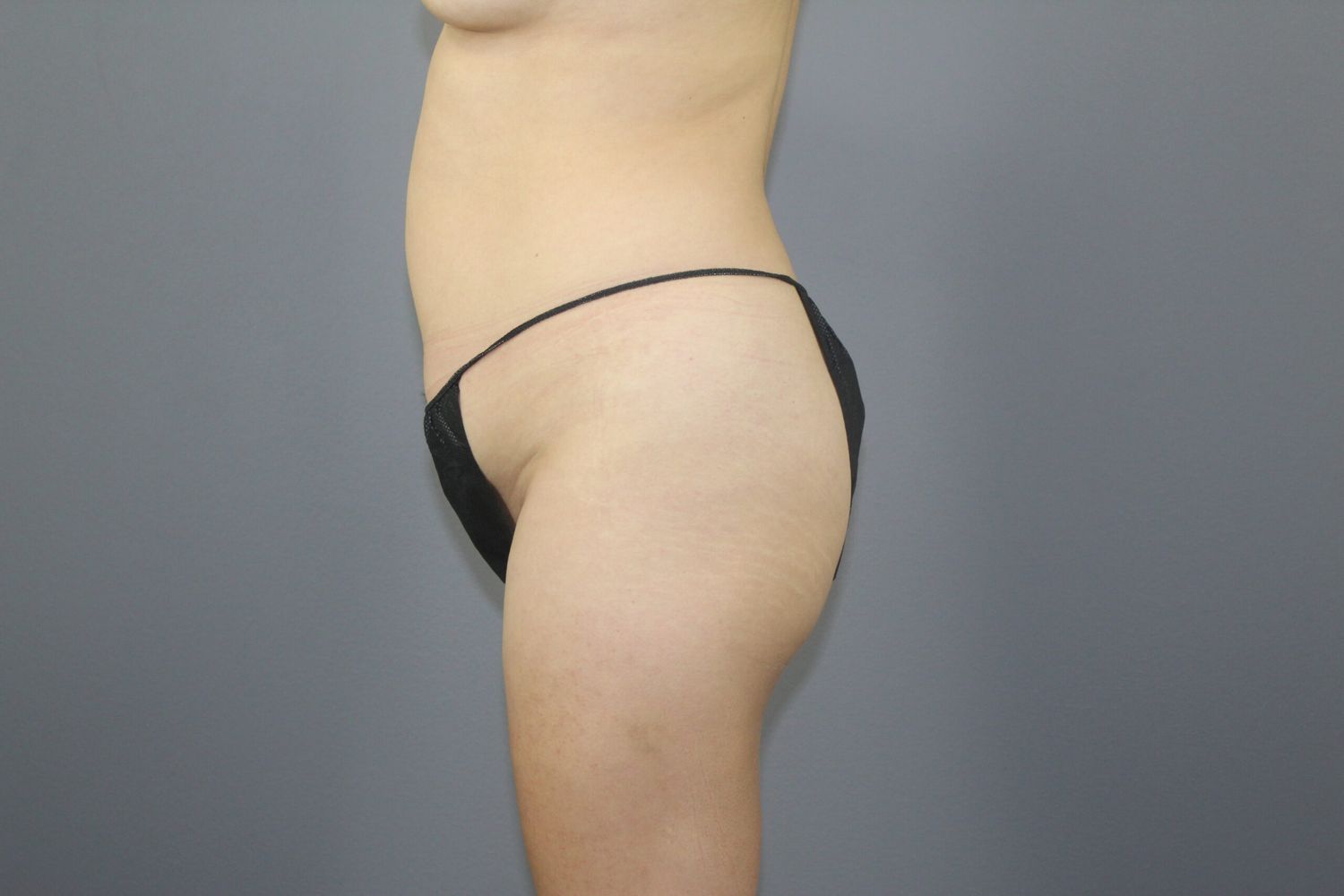 Brazilian Butt Lift Before & After