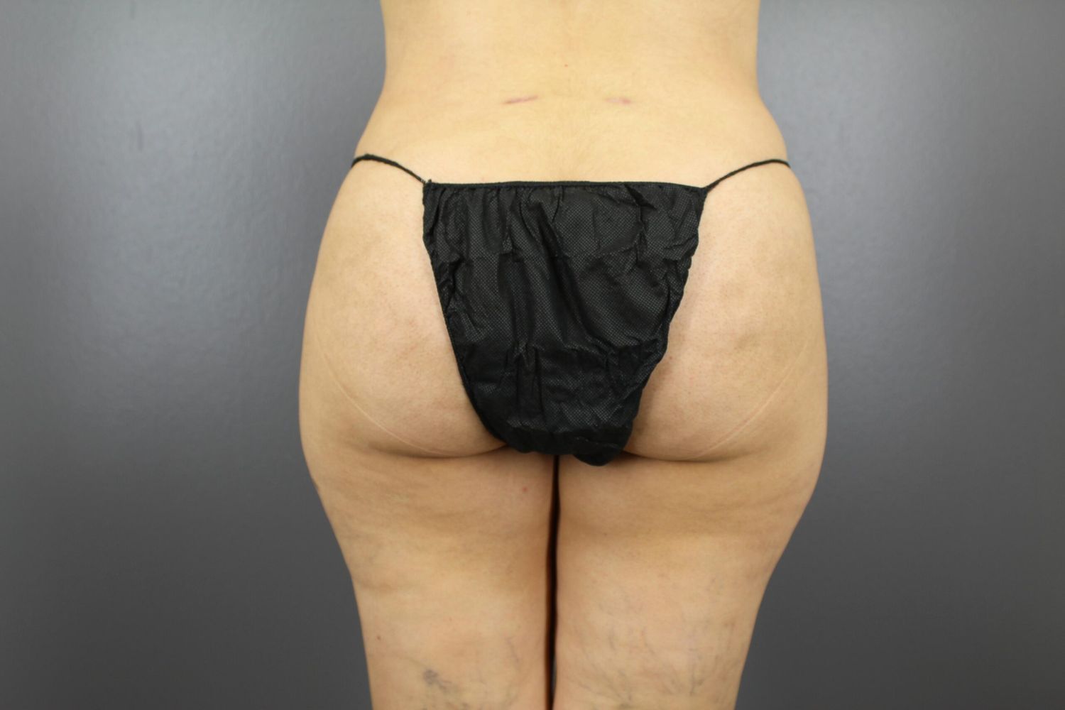 Brazilian Butt Lift Before & After
