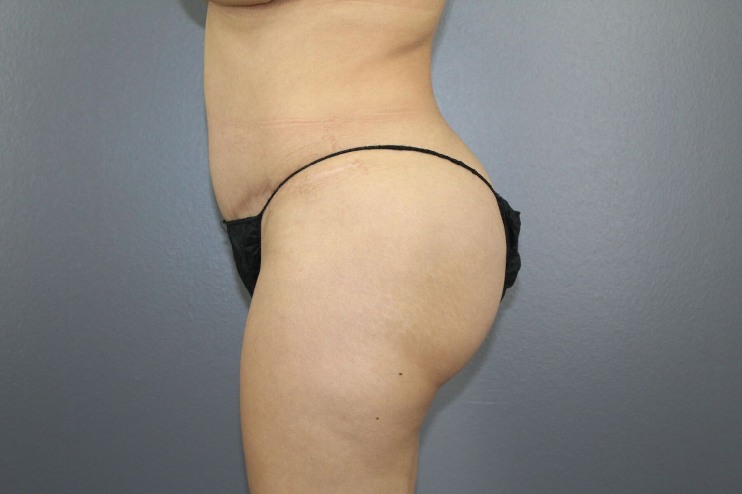 Brazilian Butt Lift Before & After