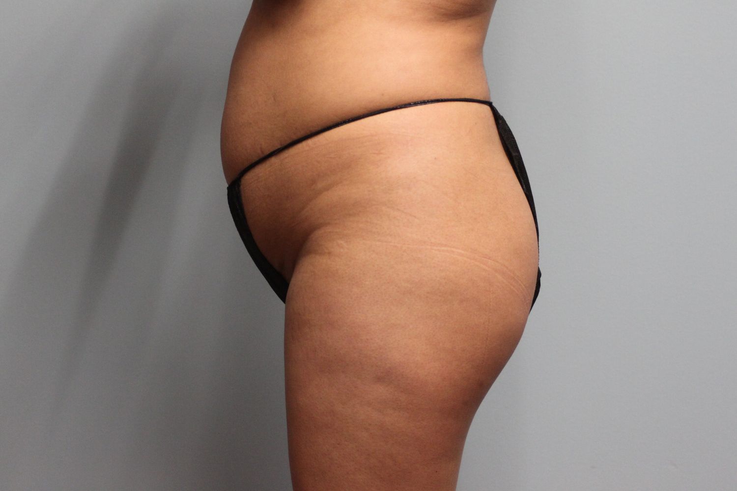 Brazilian Butt Lift Before & After