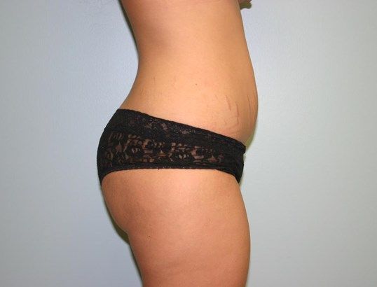 Brazilian Butt Lift Before & After