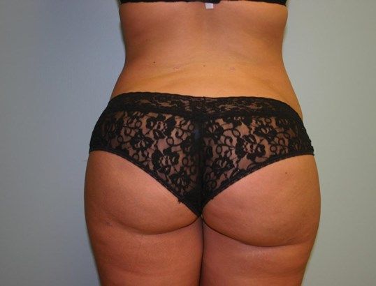 Brazilian Butt Lift Before & After