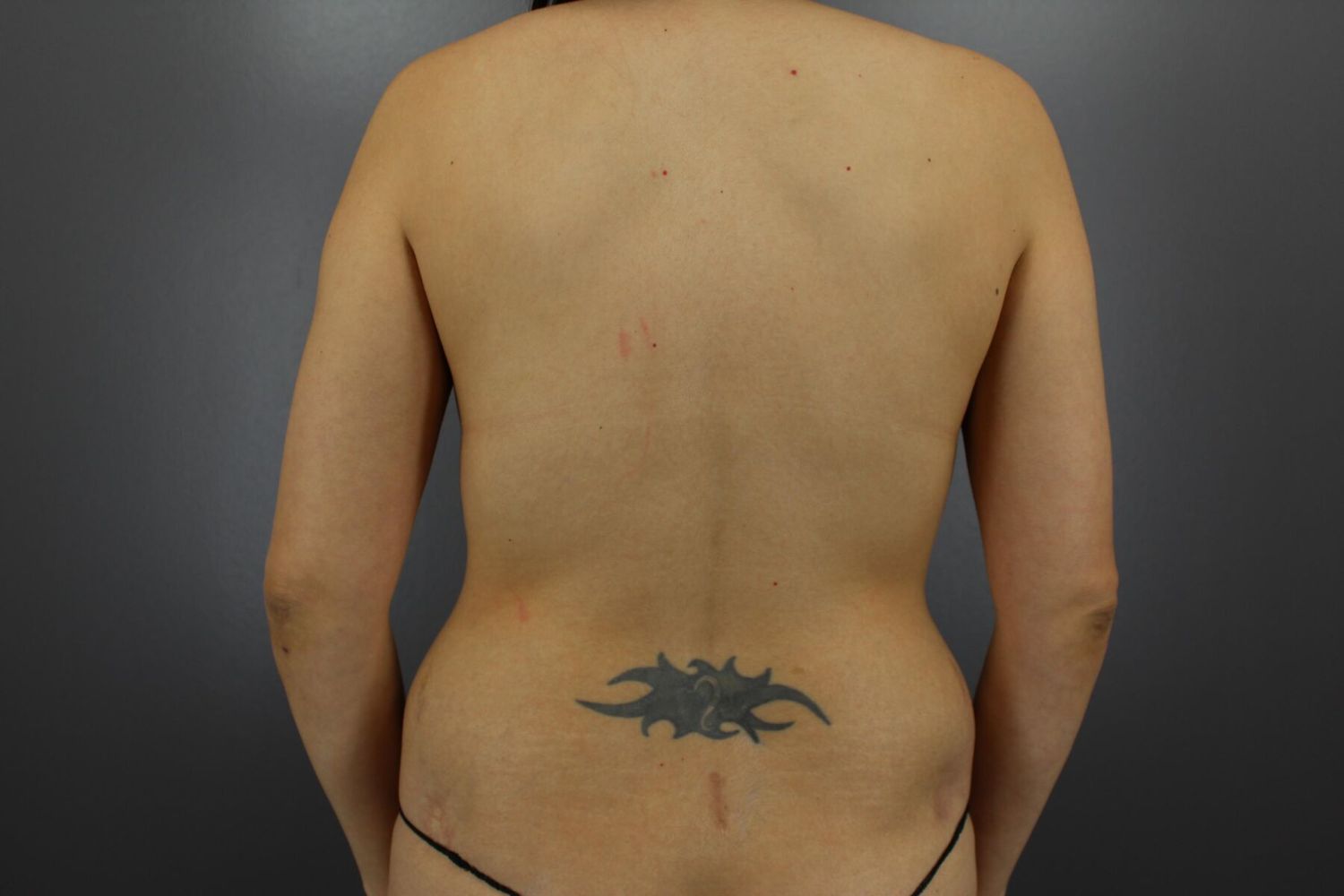 Brazilian Butt Lift Before & After