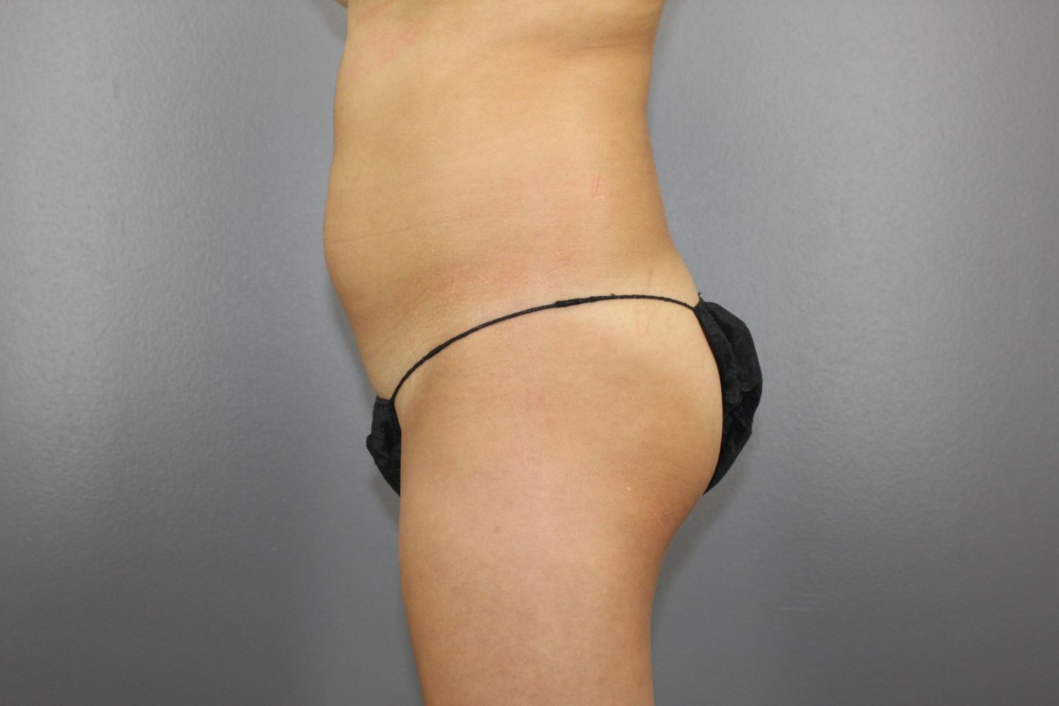 Brazilian Butt Lift Before & After