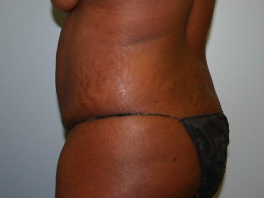 Brazilian Butt Lift Before & After