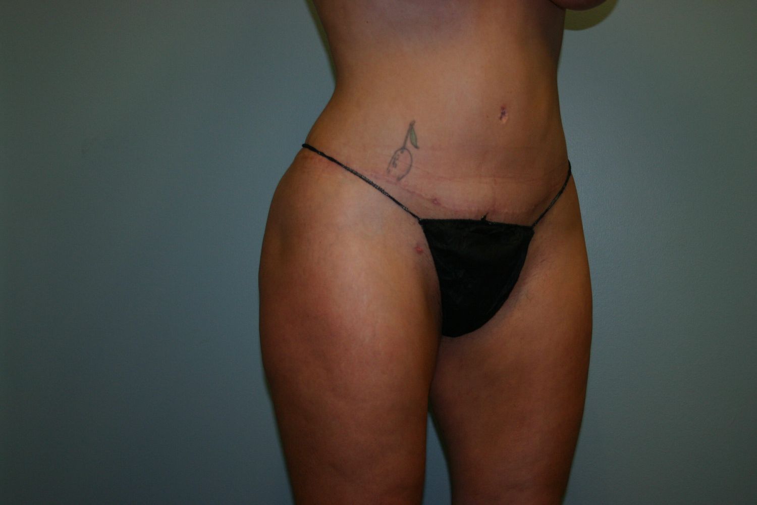 Brazilian Butt Lift Before & After