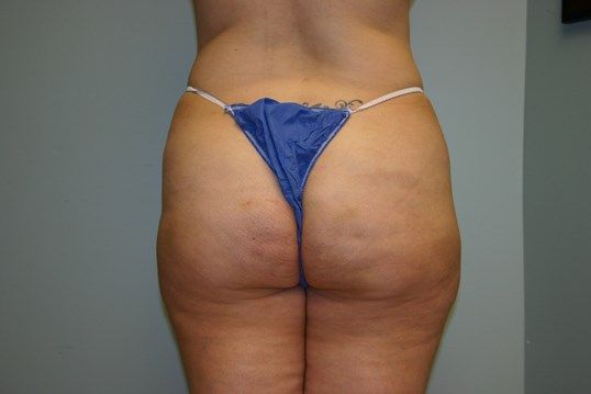 Brazilian Butt Lift Before & After