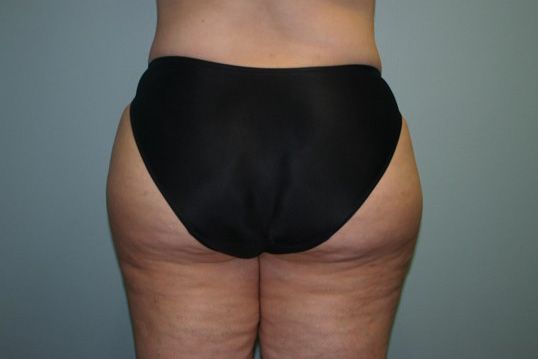 Brazilian Butt Lift Before & After