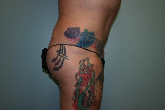 Brazilian Butt Lift Before & After