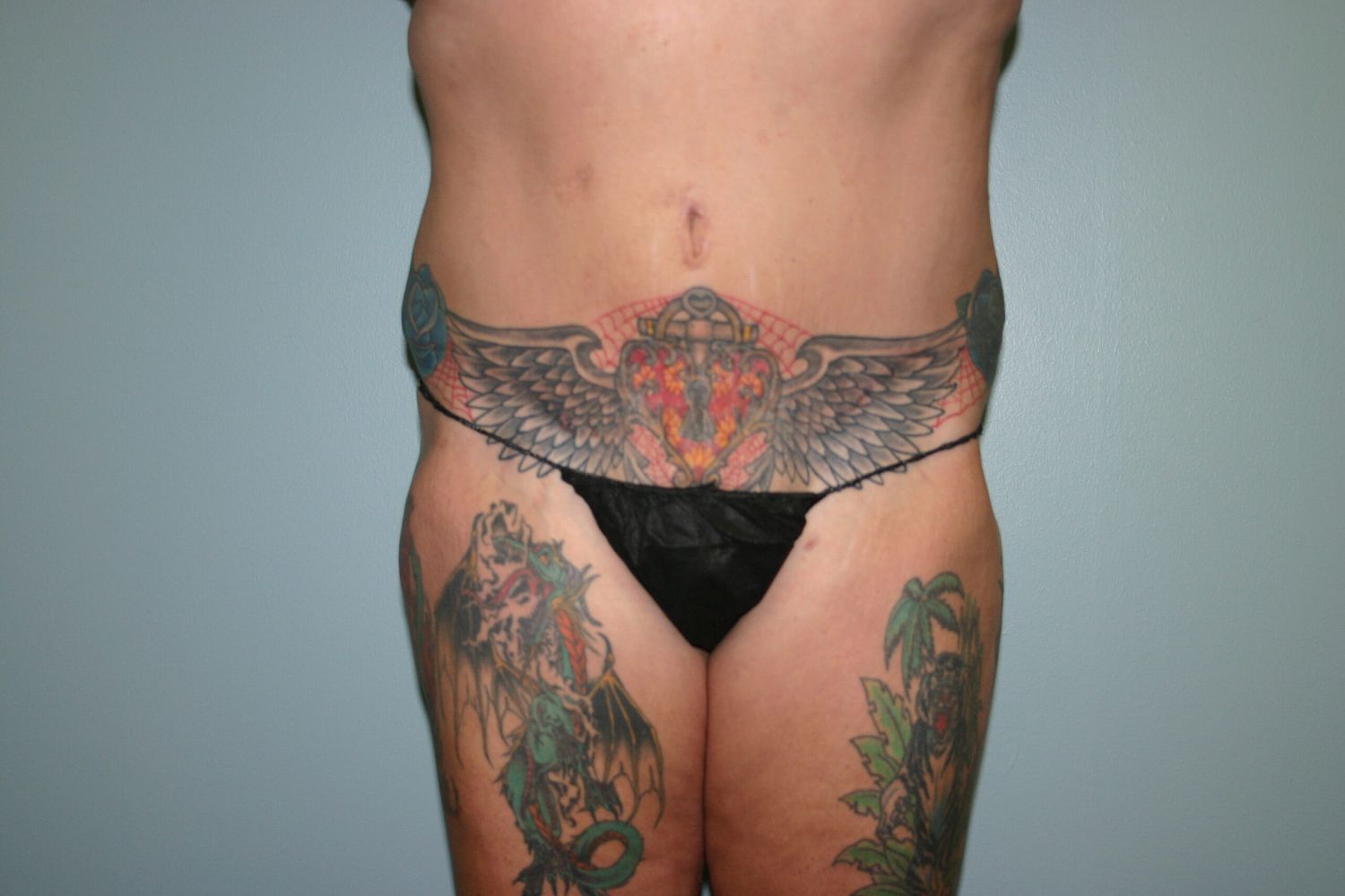 Brazilian Butt Lift Before & After