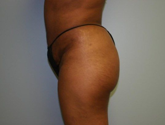 Brazilian Butt Lift Before & After