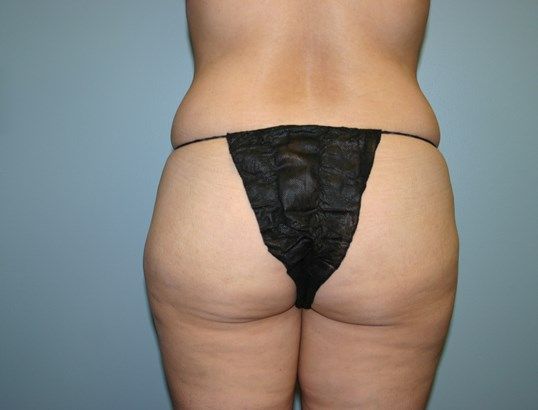 Brazilian Butt Lift Before & After
