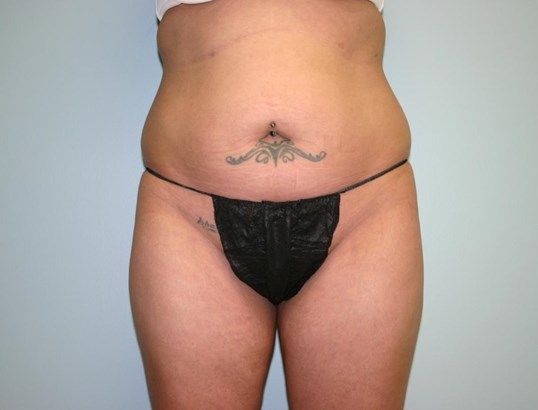 Brazilian Butt Lift Before & After
