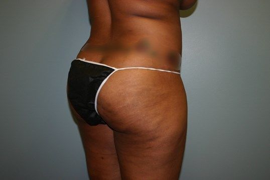 Brazilian Butt Lift Before & After