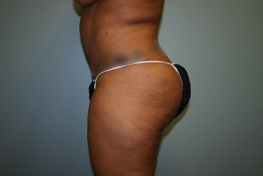 Brazilian Butt Lift Before & After