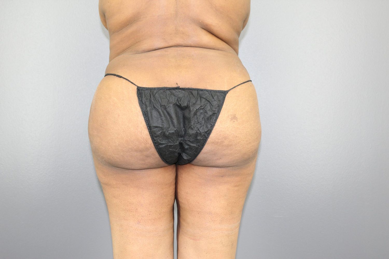 Brazilian Butt Lift Before & After