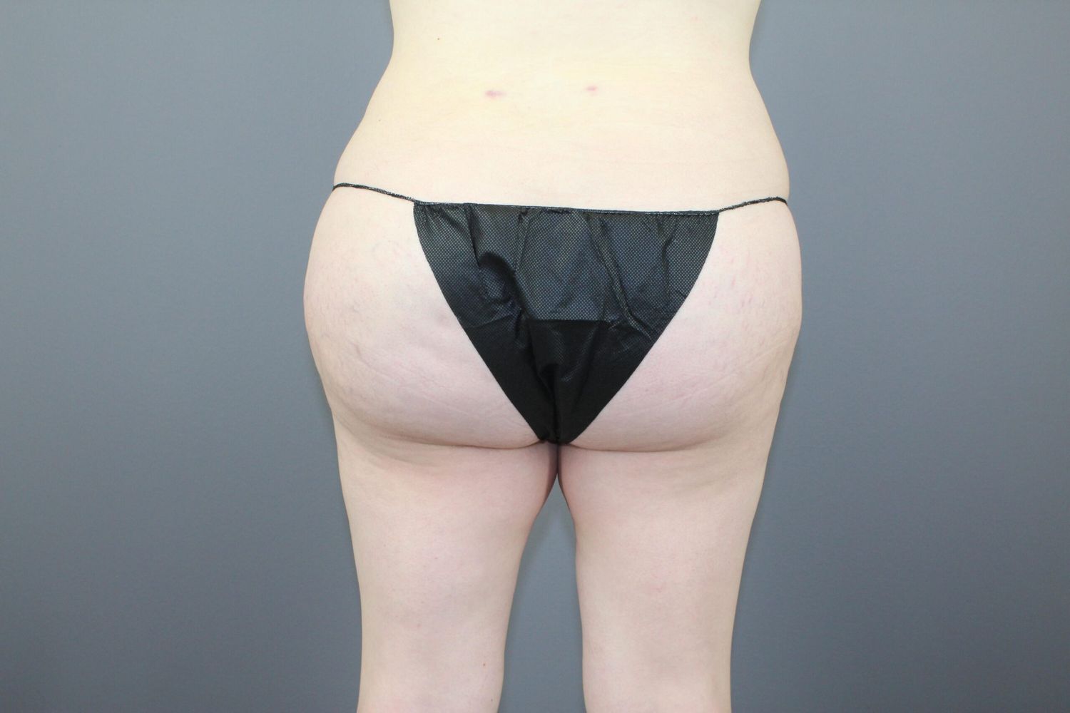 Brazilian Butt Lift Before & After