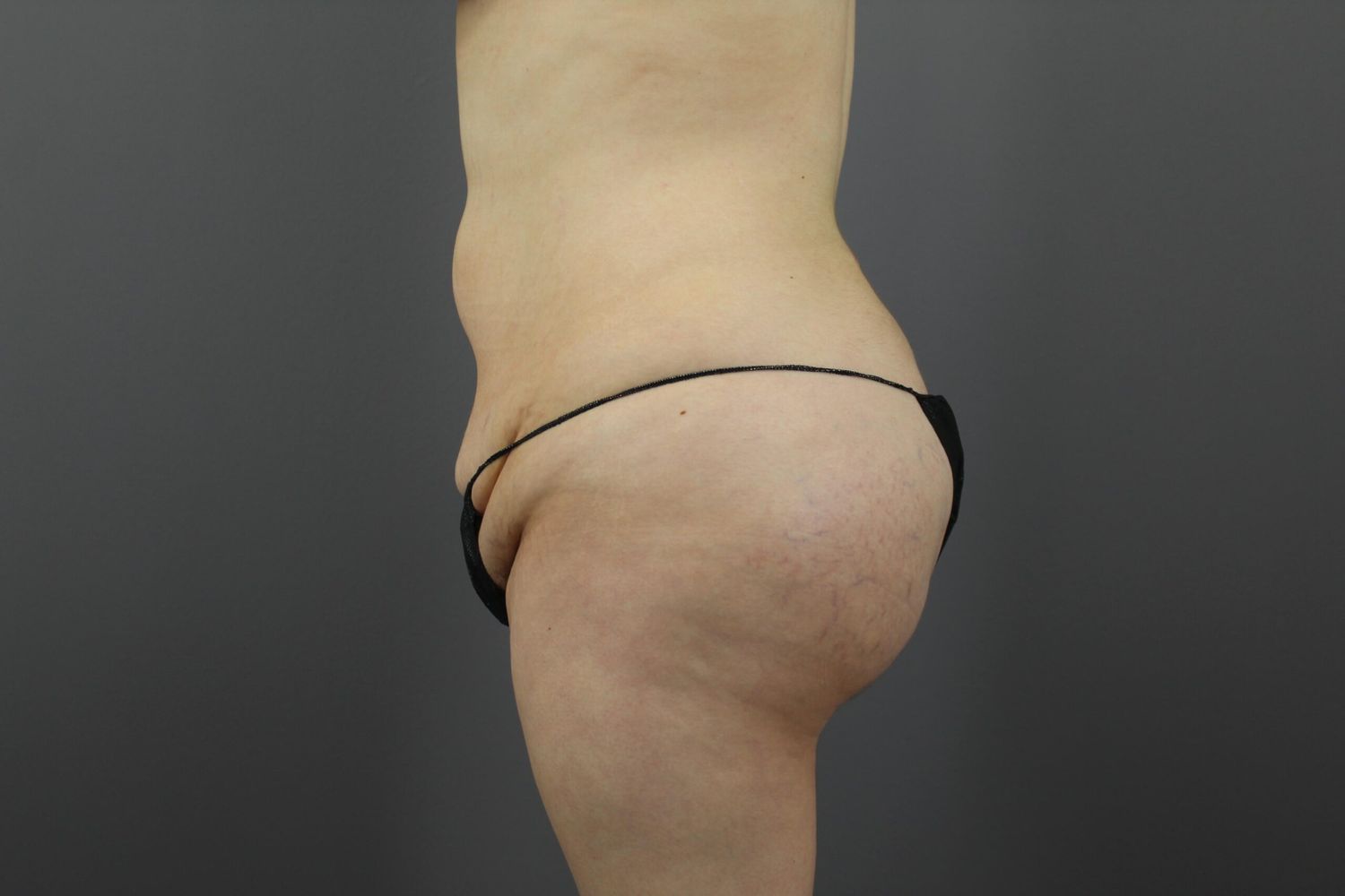 Brazilian Butt Lift Before & After