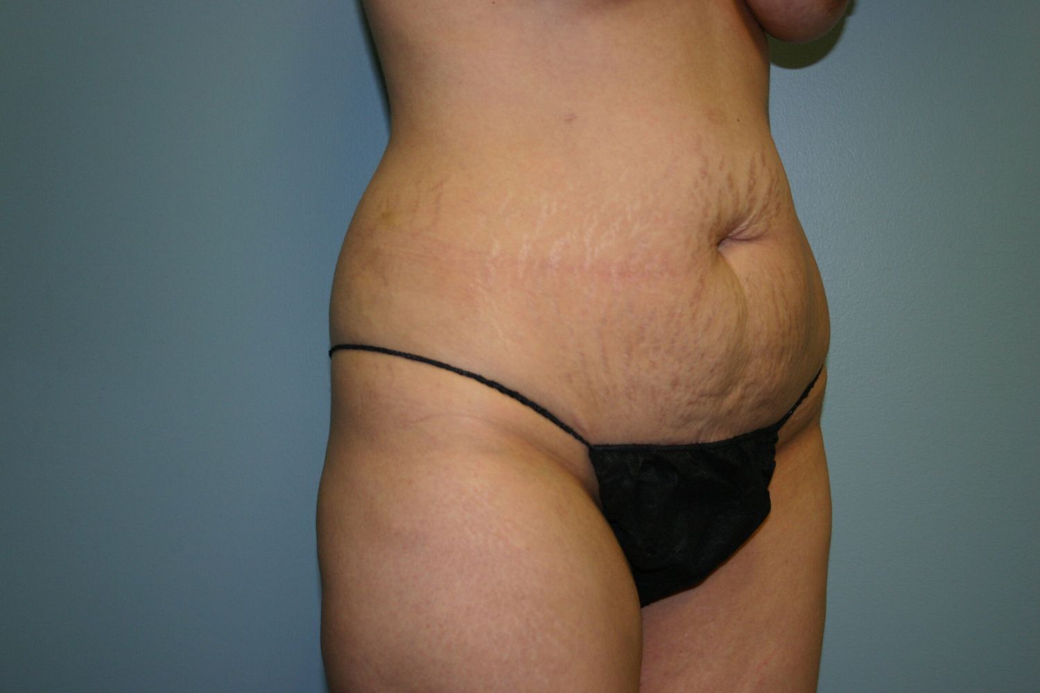 Liposuction Before & After