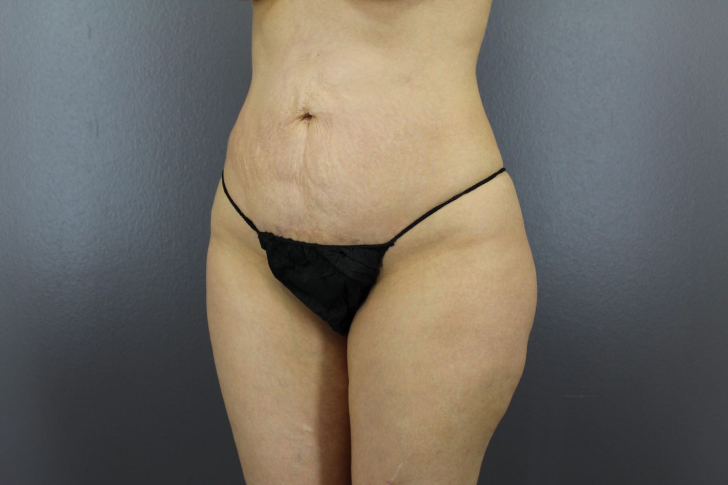 Liposuction Before & After