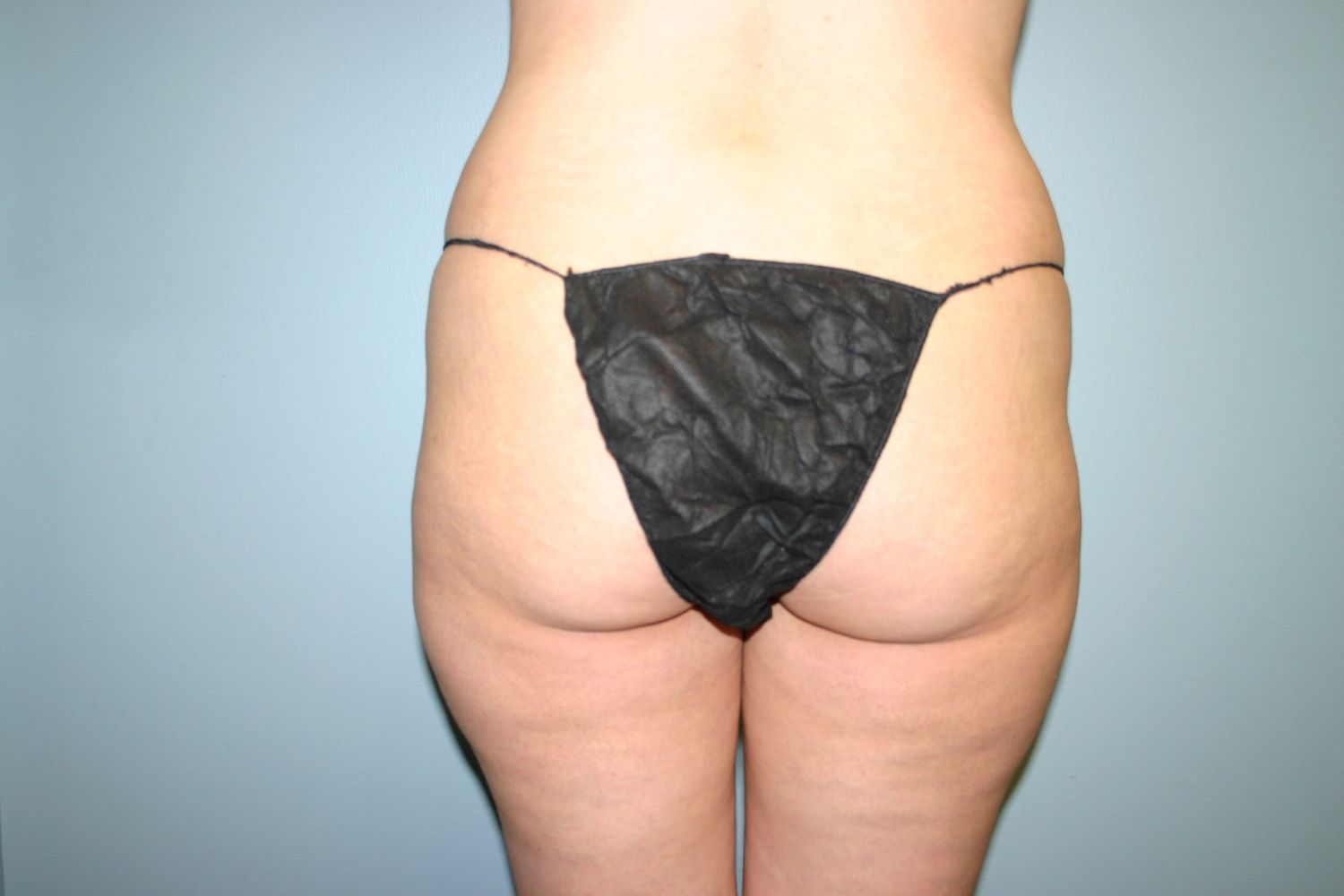 Liposuction Before & After