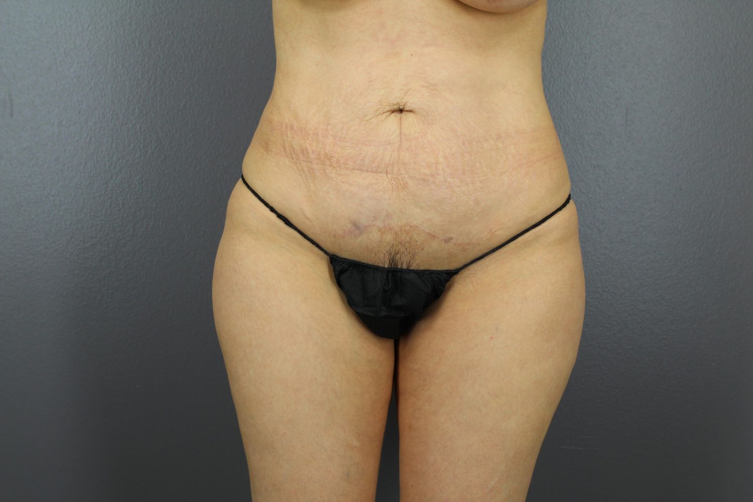 Liposuction Before & After