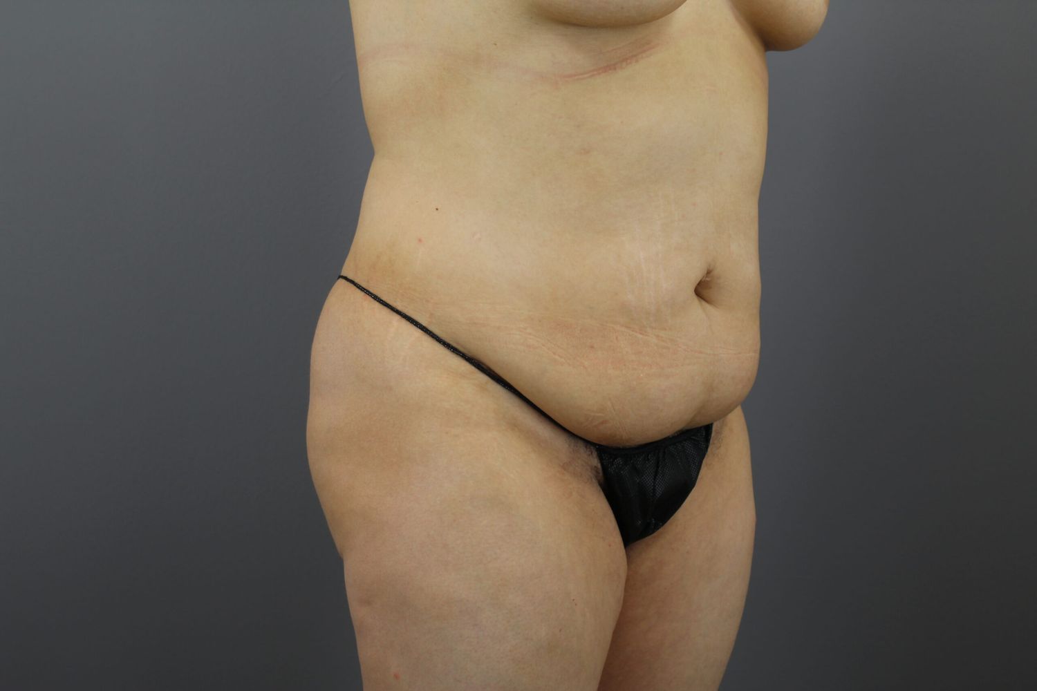 Liposuction Before & After