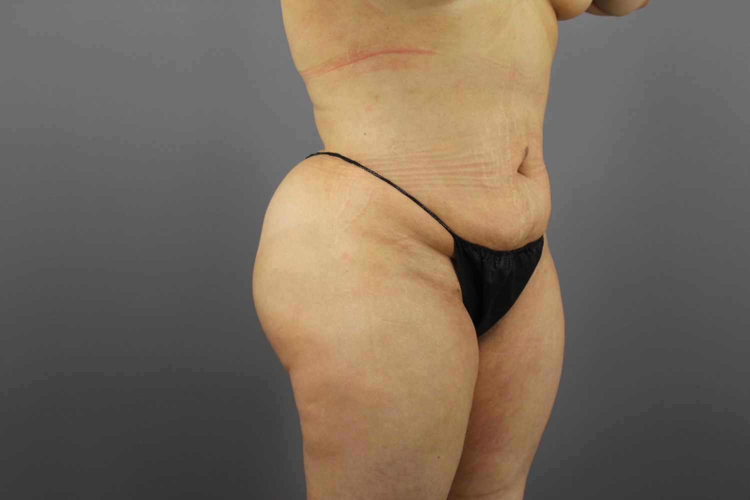 Liposuction Before & After