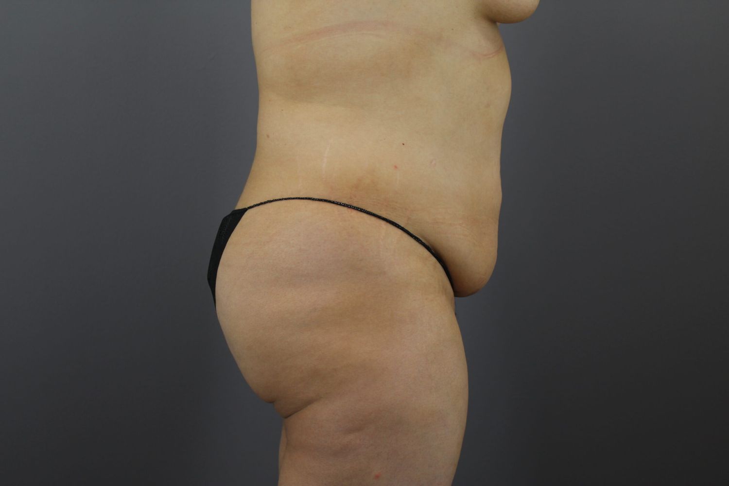 Liposuction Before & After