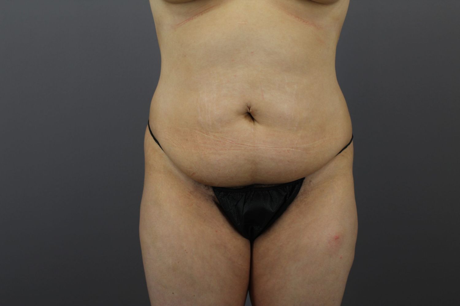 Liposuction Before & After
