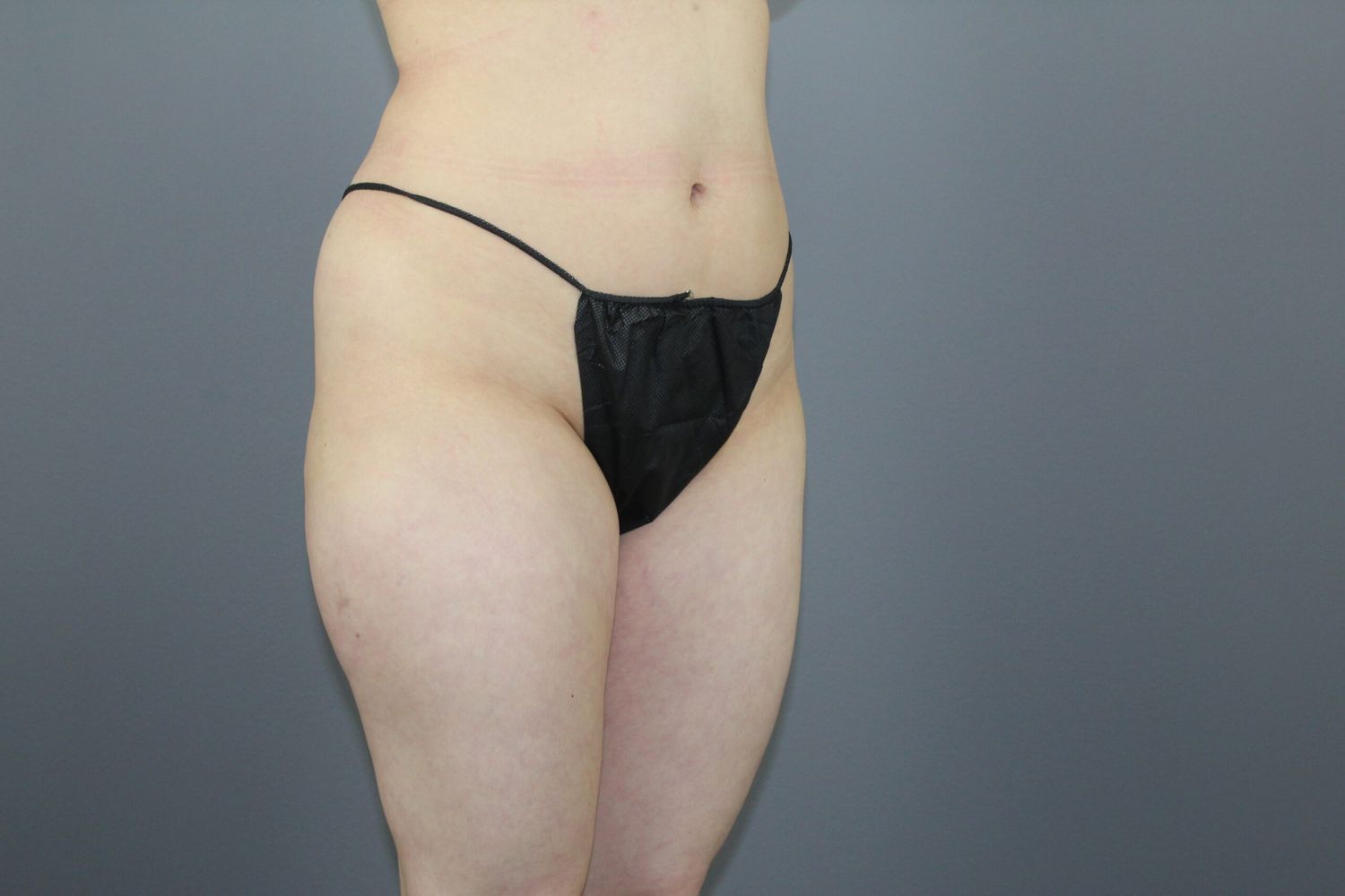 Liposuction Before & After