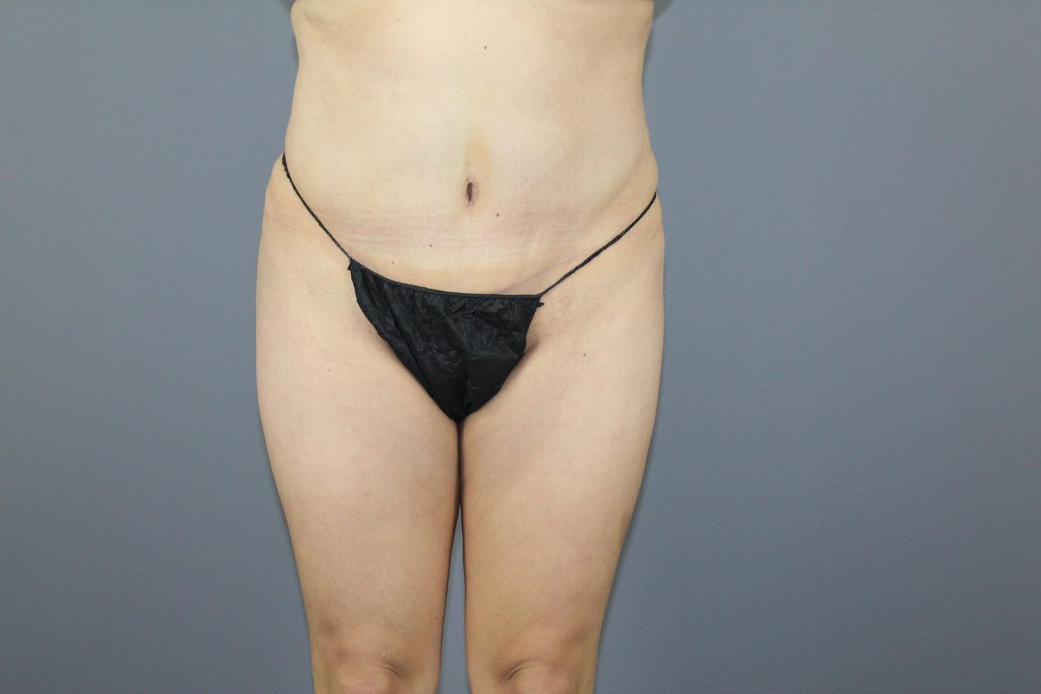 Liposuction Before & After
