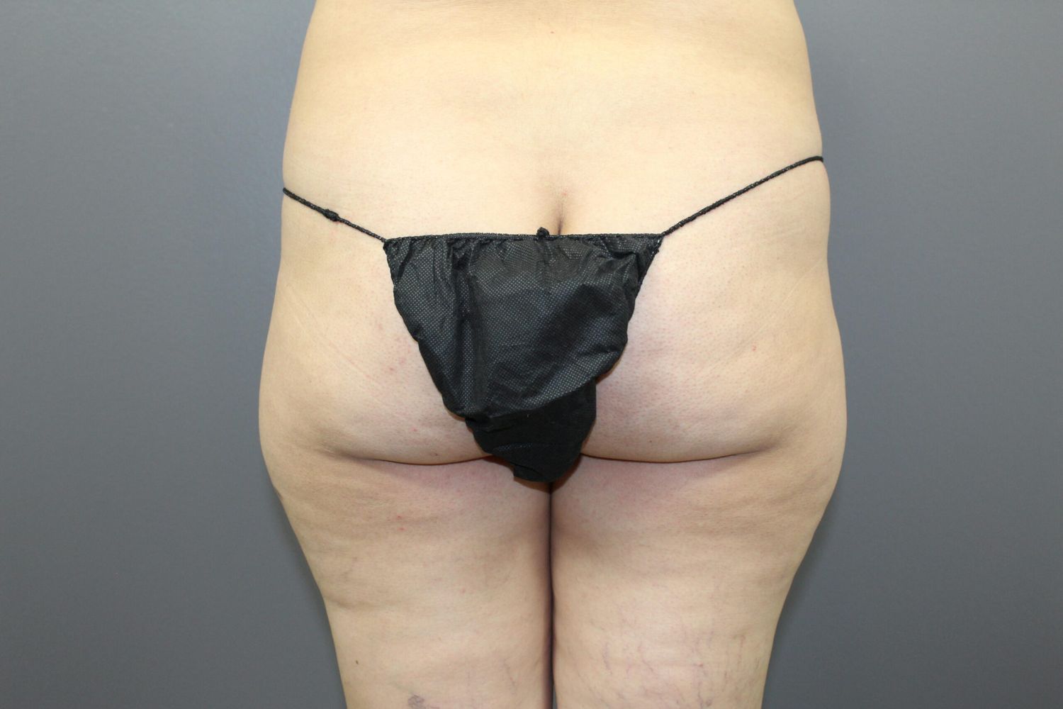 Liposuction Before & After