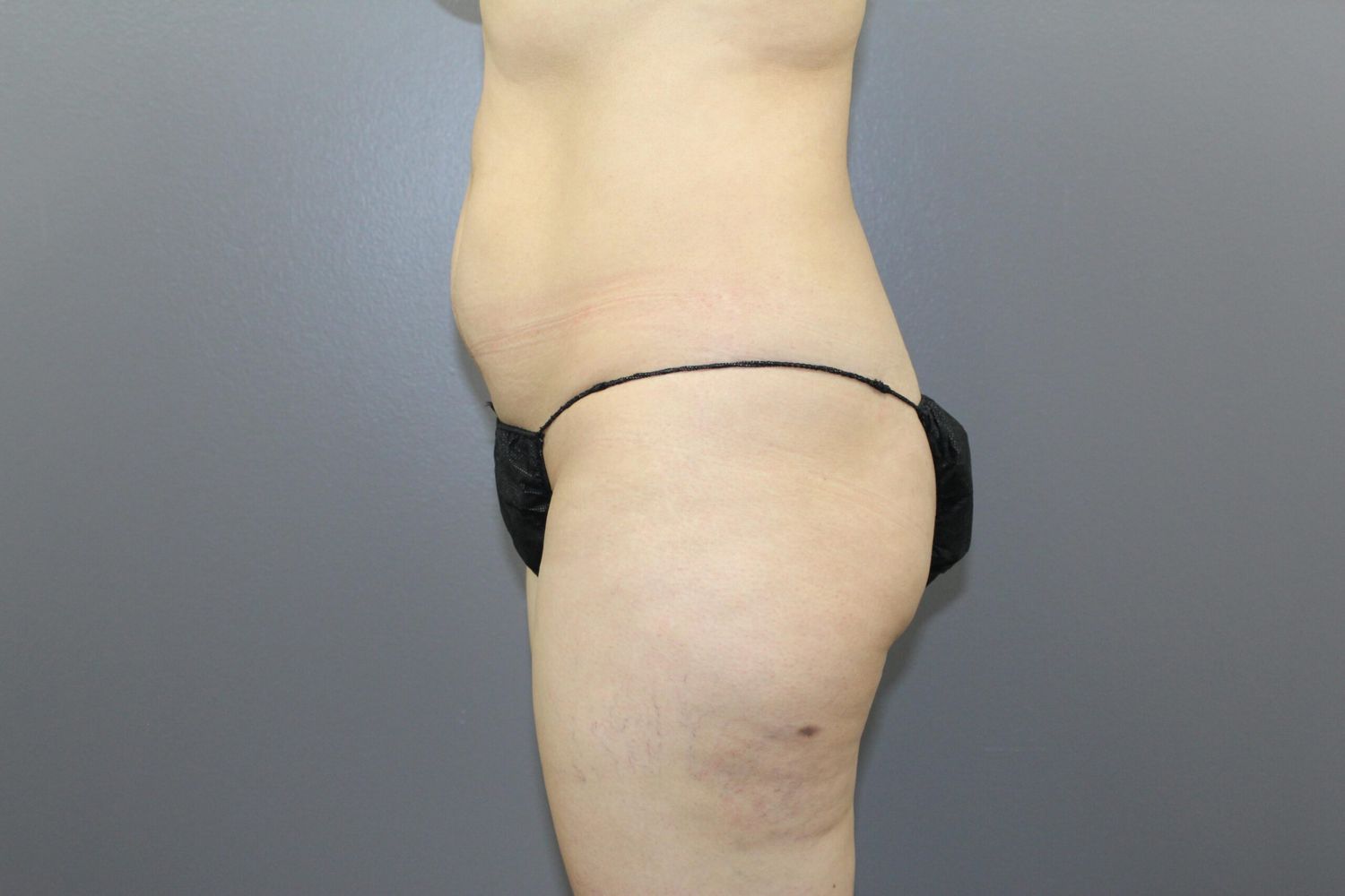Liposuction Before & After