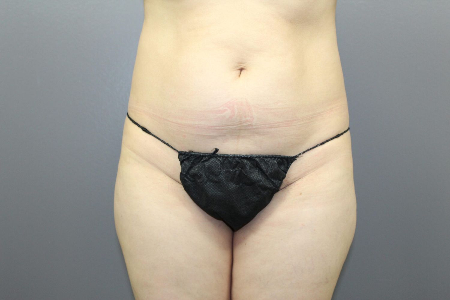 Liposuction Before & After