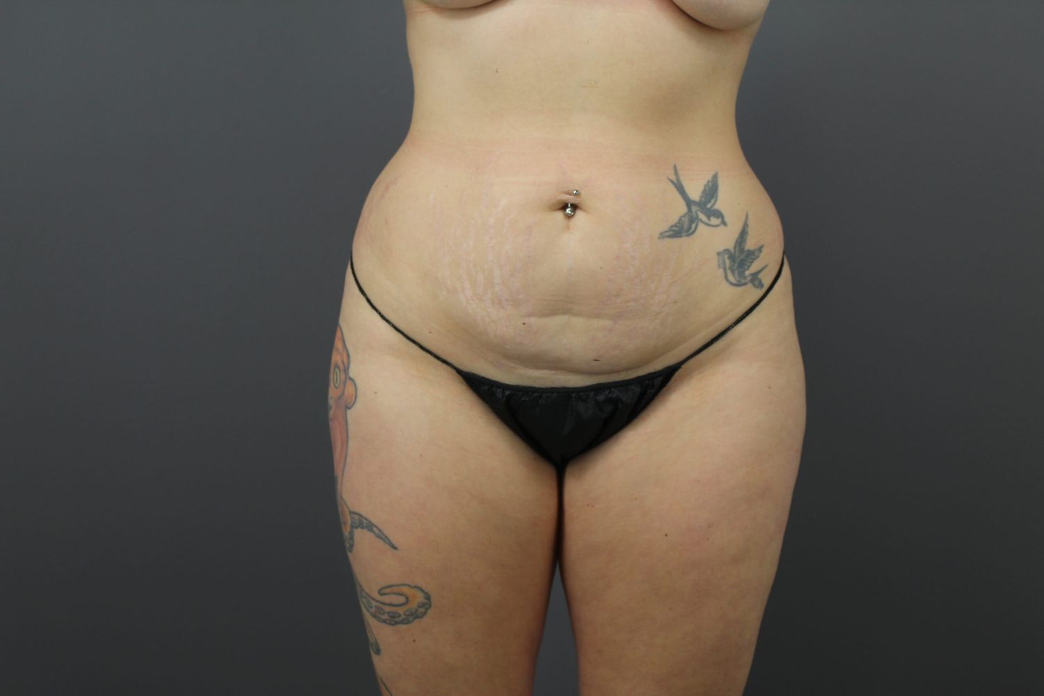 Liposuction Before & After