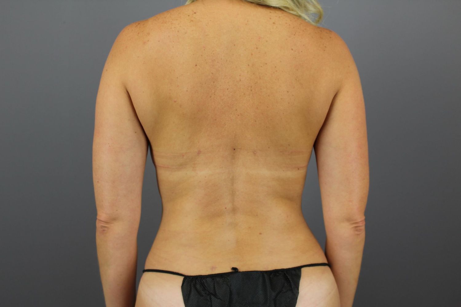 Liposuction Before & After