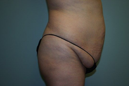 Liposuction Before & After
