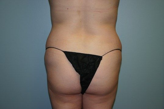 Liposuction Before & After