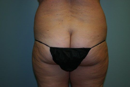 Liposuction Before & After