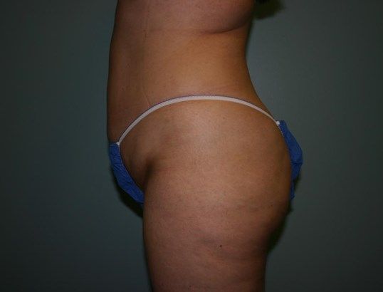 Liposuction Before & After