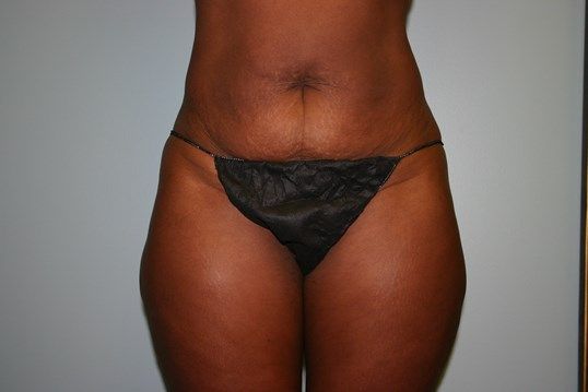 Liposuction Before & After